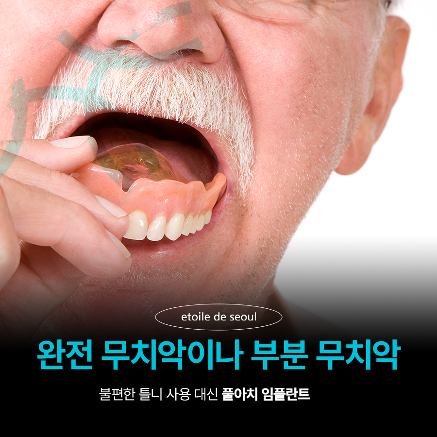 압구정로데오역 치과 불편한 틀니 대신 풀아치 임플란트! 관련 이미지 2