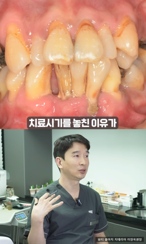 임플란트의 역사와 구조, 풀아치 임플란트 구조 차이점 비교 관련 이미지 8