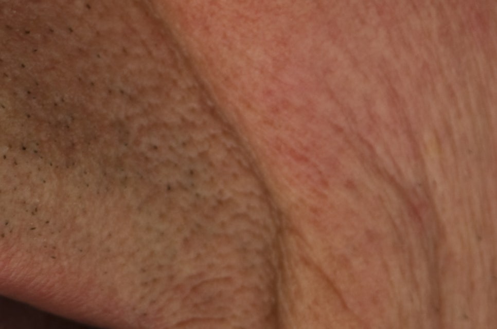 압구정로데오역 치과 불편한 틀니 대신 풀아치 임플란트! 관련 이미지 21