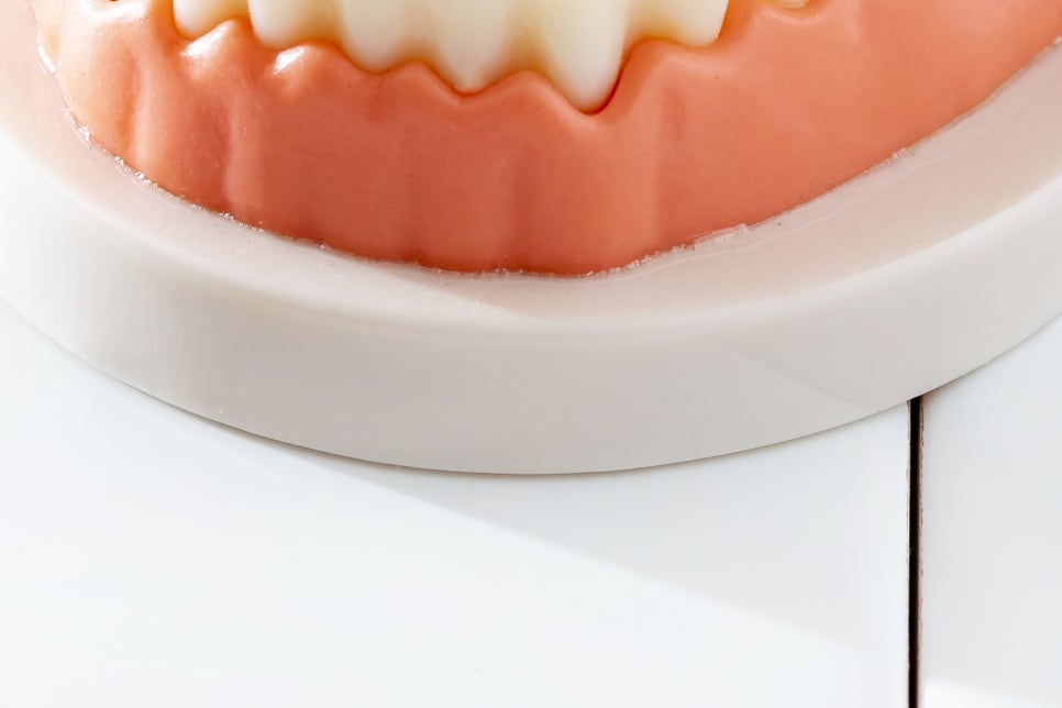 강남 어금니 임플란트 고려가 필요한 4가지! 관련 이미지 16