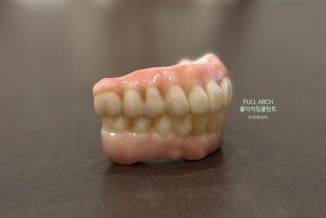 풀아치임플란트 무엇? full-arch Process 부작용과 주의할 점. 관련 이미지 2