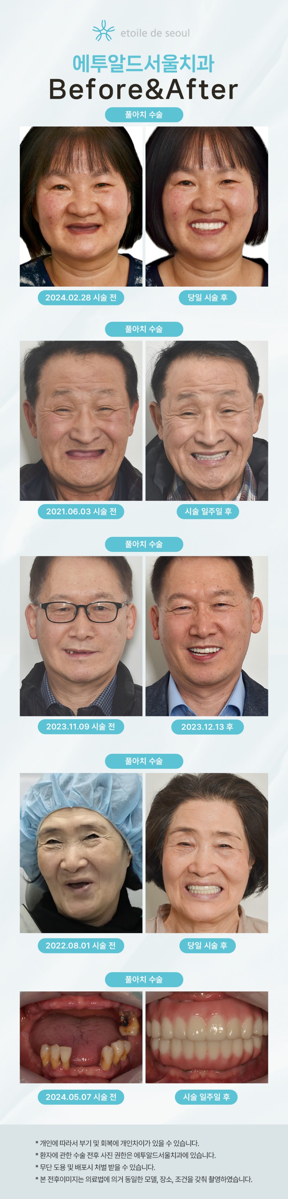 뼈이식 임플란트 주의사항 및 대안방법 관련 이미지 13