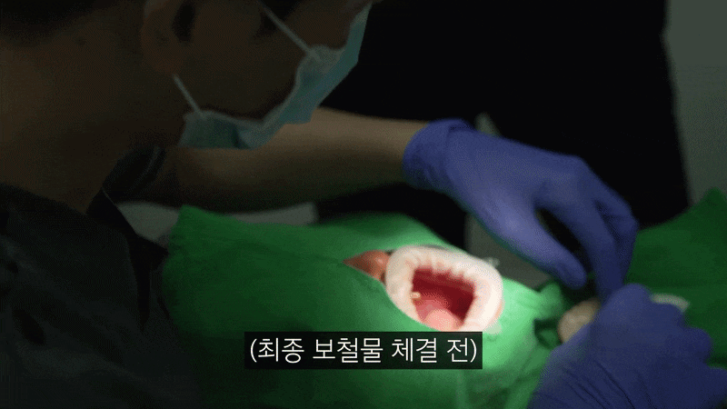 전체 임플란트 가격 보험 적용 어디까지 되는지 정리해 드릴게요 관련 이미지 4