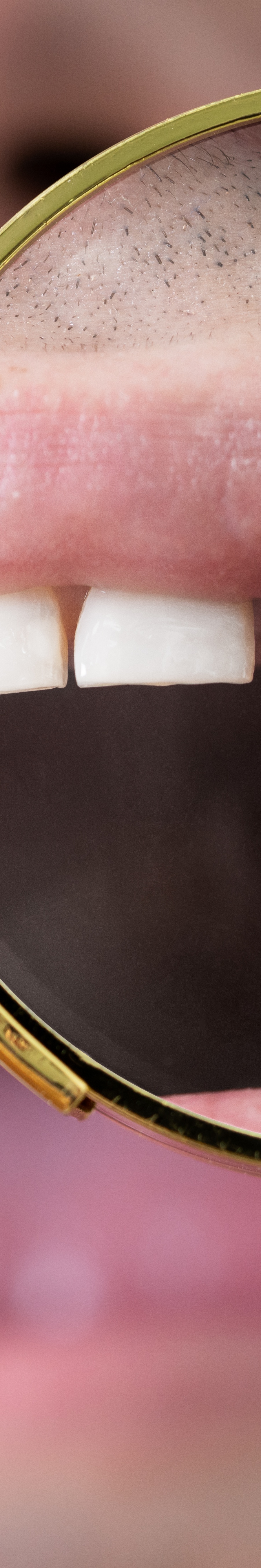 올온엑스 임플란트 과연 해결이 가능할까 관련 이미지 33