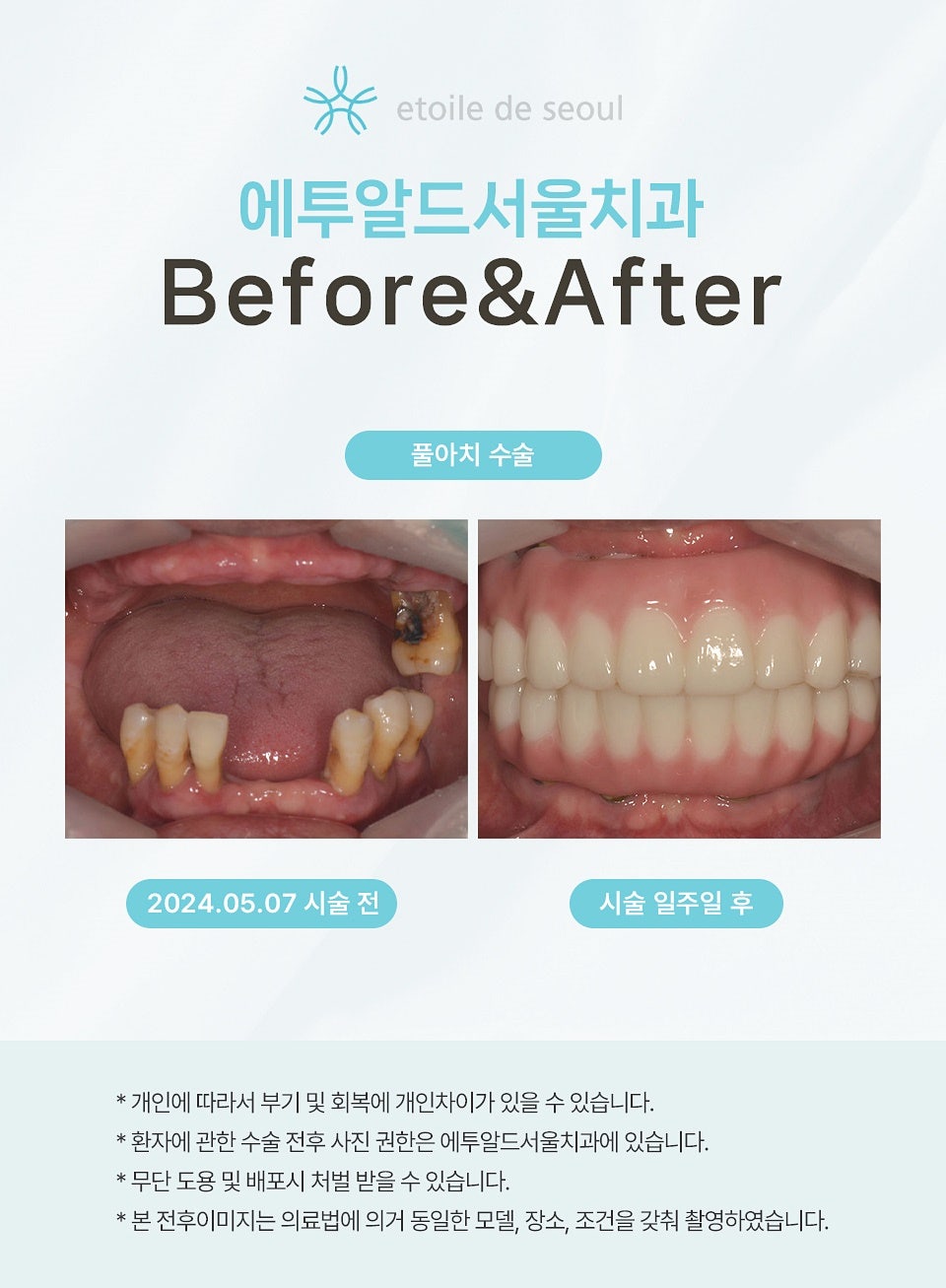 전체임플란트 비용 차이 알아두려면 관련 이미지 6