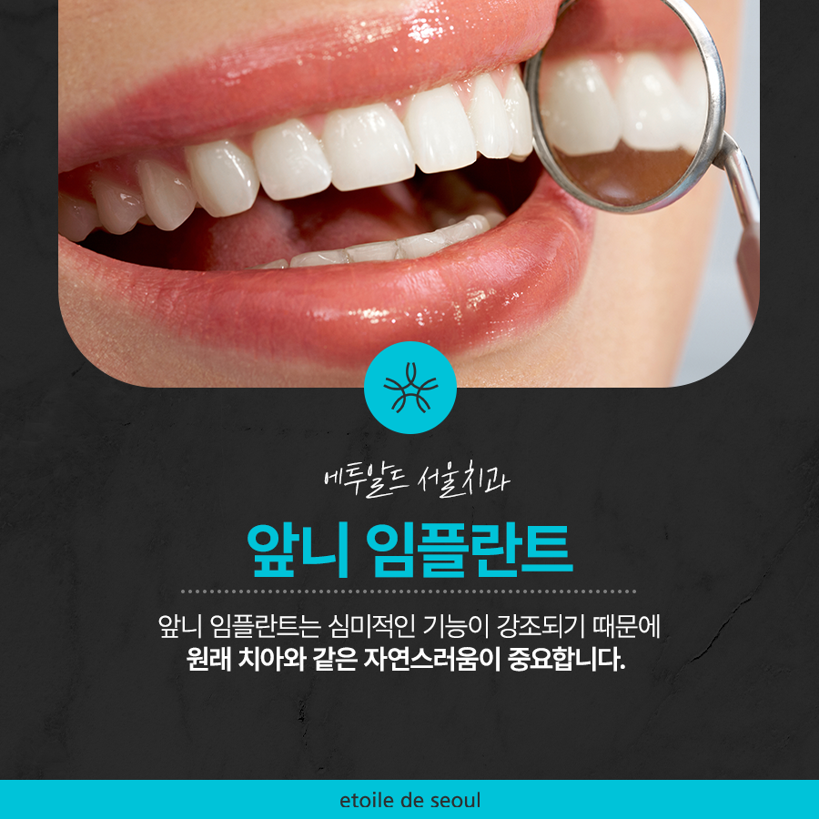 청담동치과 추천 앞니가 부러졌어요! 관련 이미지 2