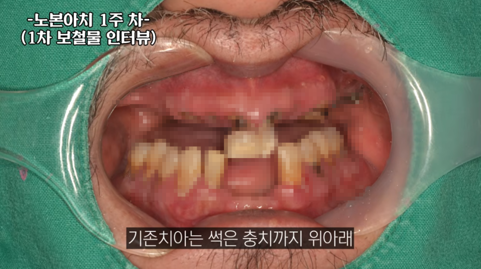 노본아치 임플란트 가격, 비싸면 다 좋다? 궁금증을 하나씩 짚어봅니다 관련 이미지 6