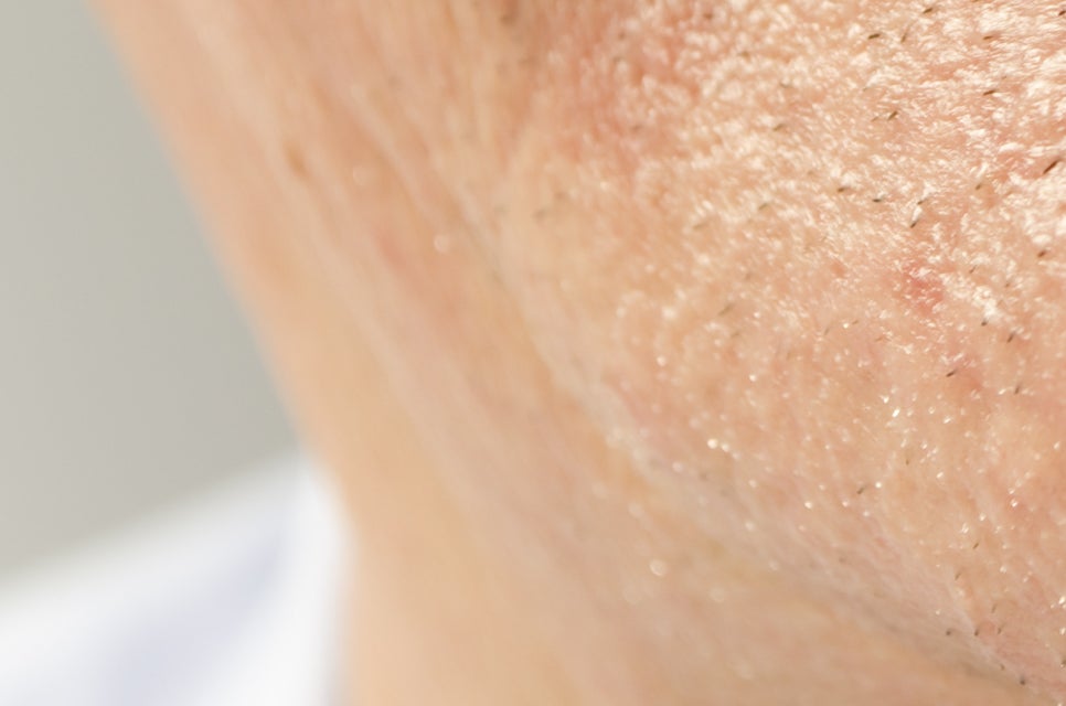 압구정로데오역 치과 불편한 틀니 대신 풀아치 임플란트! 관련 이미지 25