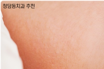 청담동치과 추천 앞니가 부러졌어요! 관련 이미지 10