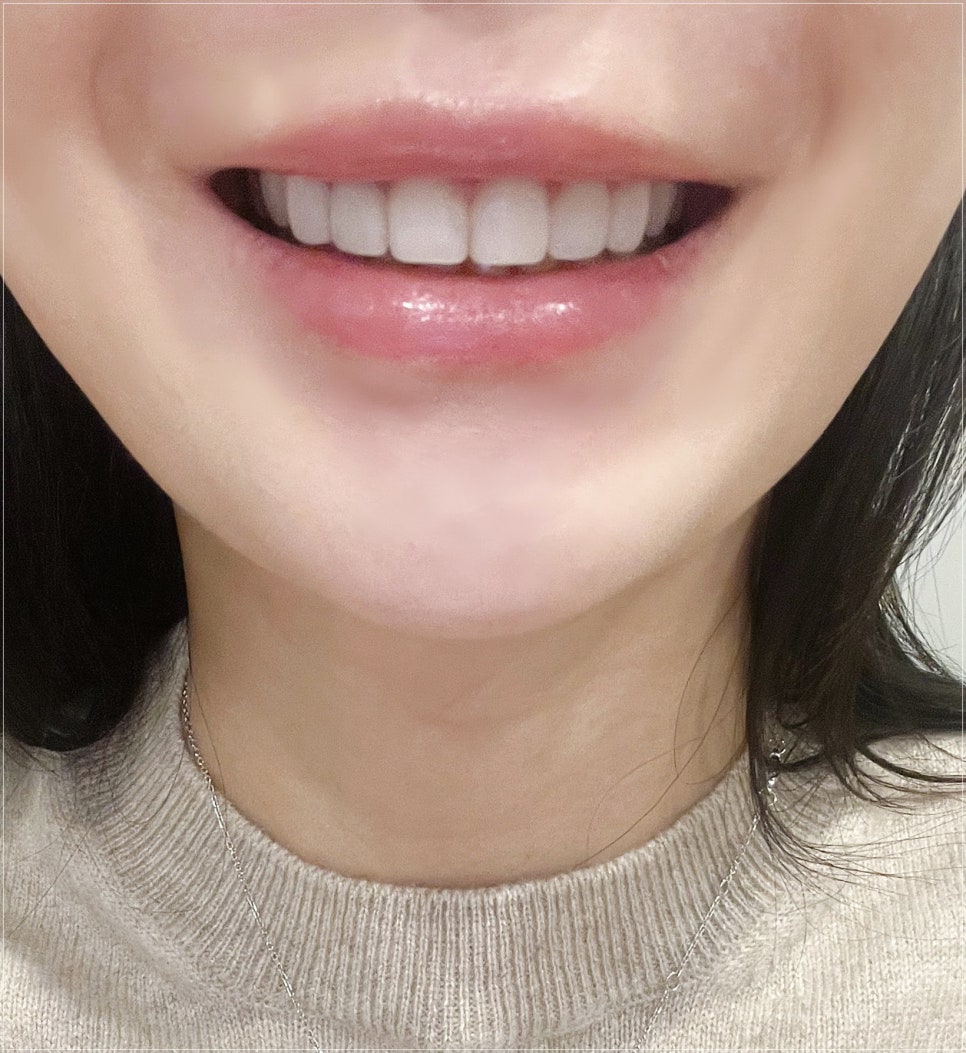 무삭제 라미네이트 비용 상담 후에 결정해야 하는 이유 관련 이미지 3