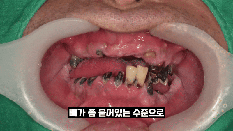 올온엑스 임플란트 과연 해결이 가능할까 관련 이미지 4