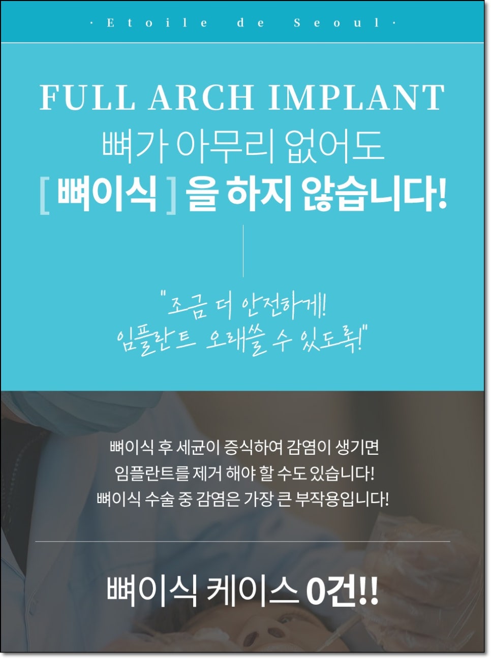 전체 임플란트 후기, 한 악에 4개부터 10개까지 개수와 가격이 달라지는 이유와 사례 3가지 관련 이미지 4