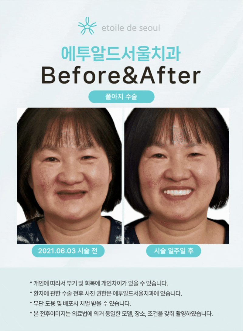 압구정 풀아치 임플란트 비교 기준 관련 이미지 3