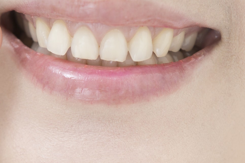 학동사거리 치과 무치악 임플란트 고민이라면 관련 이미지 22