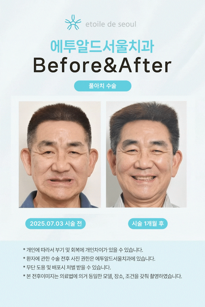 강남뼈이식임플란트 비용 확인한다면 관련 이미지 3