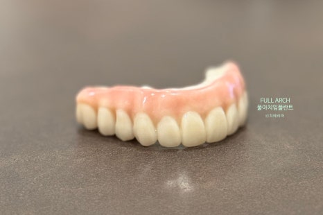 풀아치임플란트 무엇? full-arch Process 부작용과 주의할 점. 관련 이미지 1