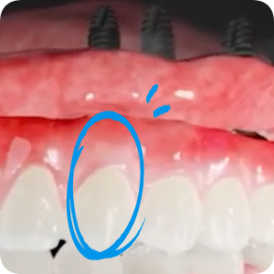 풀아치 임플란트 왜 풀아치정품보철 이어야 할까? 관련 이미지 5