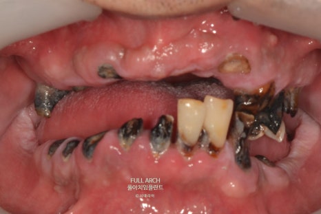 풀아치임플란트 무엇? full-arch Process 부작용과 주의할 점. 관련 이미지 6