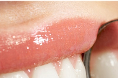 청담동치과 추천 앞니가 부러졌어요! 관련 이미지 20