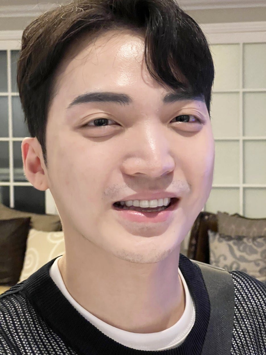 치아라미네이트 과정 후기 알아보자 관련 이미지 9