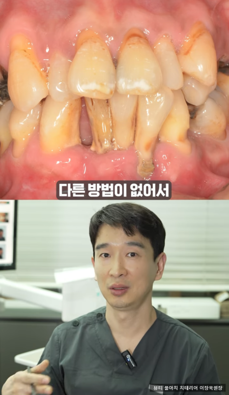 임플란트의 역사와 구조, 풀아치 임플란트 구조 차이점 비교 관련 이미지 10