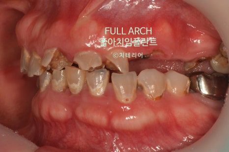 풀아치임플란트 무엇? full-arch Process 부작용과 주의할 점. 관련 이미지 10