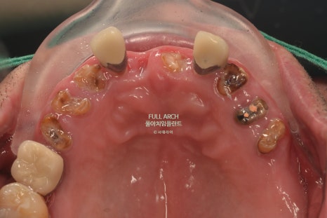 풀아치임플란트 무엇? full-arch Process 부작용과 주의할 점. 관련 이미지 4