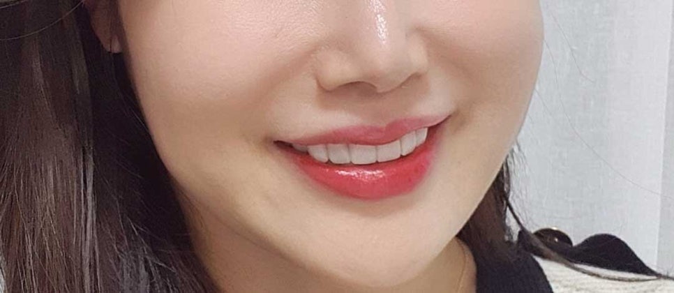 청담 앞니 라미네이트 가격 싸다고 덥석 정하면 후회합니다 관련 이미지 7