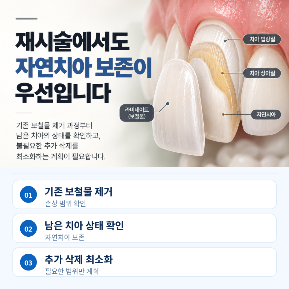 라미네이트 재시술, 떼기 전에 관련 이미지 3