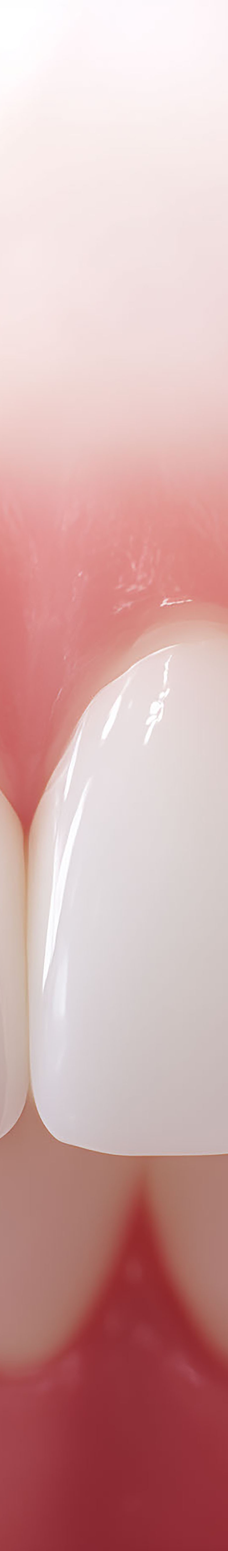 압구정로데오치과 라미네이트 어떤 포인트를 체크해야 할까 관련 이미지 23