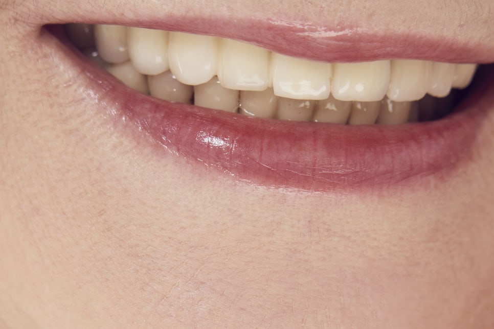 학동사거리치과 무치악 어르신들이라면? 관련 이미지 13