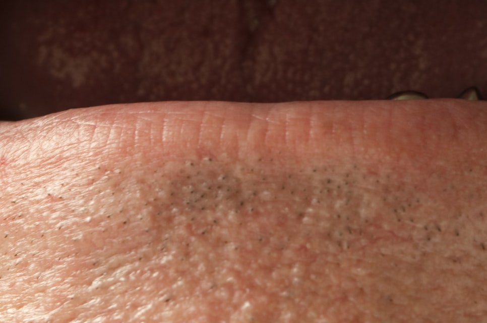 압구정로데오역 치과 불편한 틀니 대신 풀아치 임플란트! 관련 이미지 23