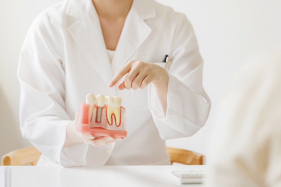 풀아치 임플란트 가격 부담될 때 알아두자 관련 이미지 5