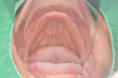 강남구청역 치과 임플란트 대체 방안 관련 이미지 5