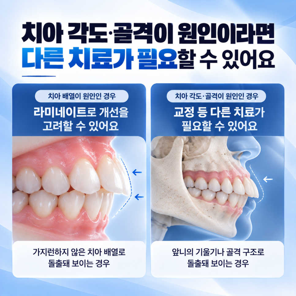 돌출입 라미네이트 가능할까요? 원인부터 짚어보면 [압구정치과] 관련 이미지 6
