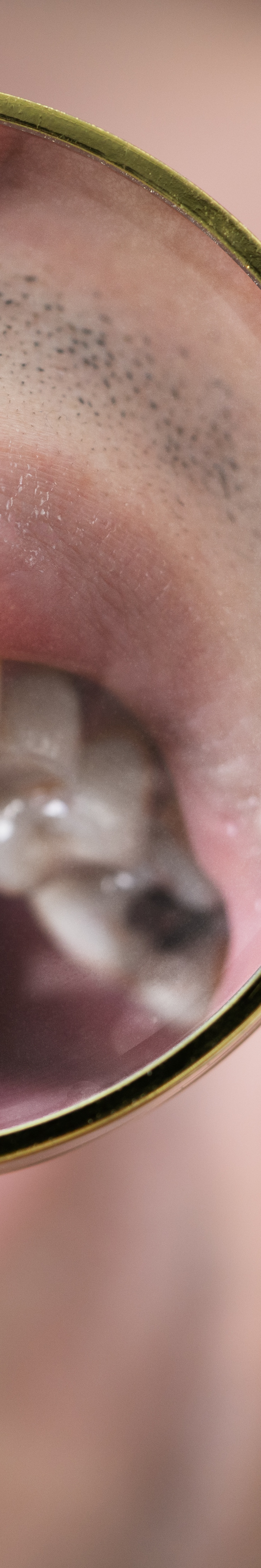 올온엑스 임플란트 과연 해결이 가능할까 관련 이미지 35