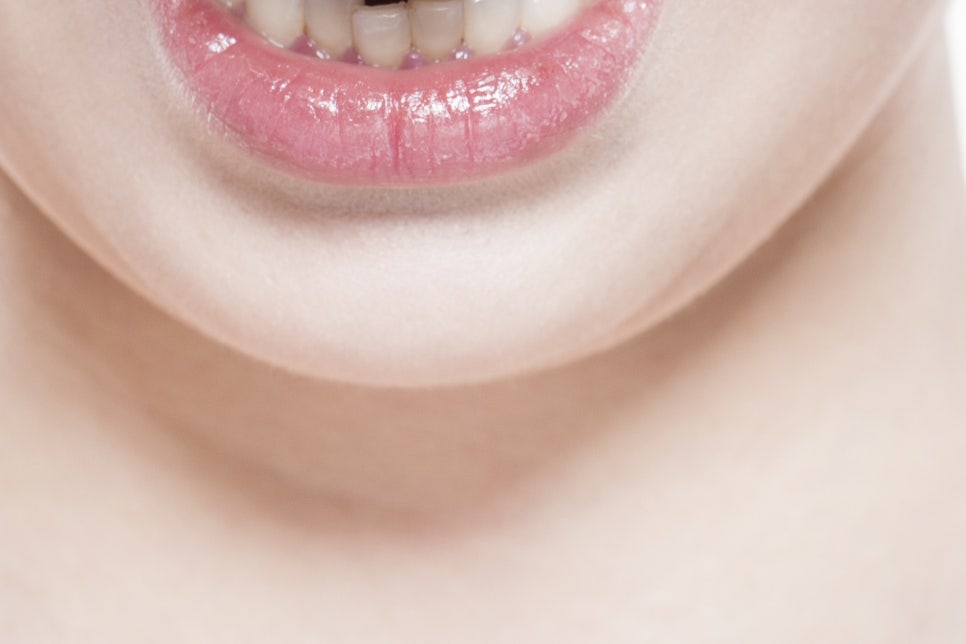 압구정로데오 임플란트틀니 새로운 미소를 찾아요 관련 이미지 22