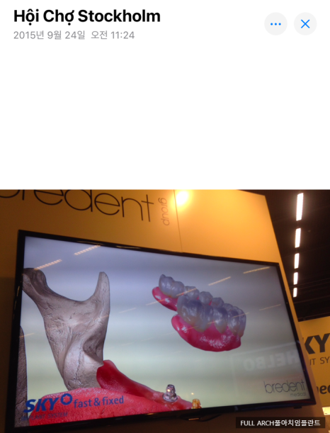 임플란트의 역사와 구조, 풀아치 임플란트 구조 차이점 비교 관련 이미지 4