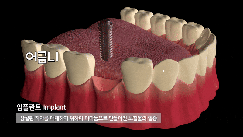 비절개임플란트 장점 왜 많은 분들이 선택할까 관련 이미지 4