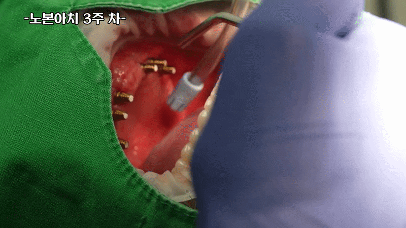 신사동 풀아치 임플란트 부작용 걱정된다면 먼저 확인하세요 관련 이미지 7