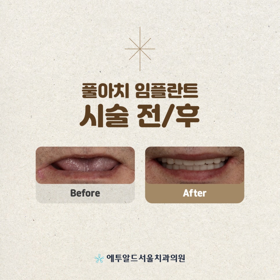 디지털 풀아치 임플란트 정말 두달이면 다 끝나나요? 관련 이미지 11