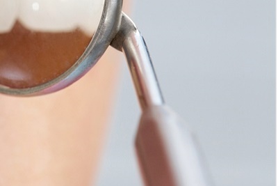 청담동치과 추천 앞니가 부러졌어요! 관련 이미지 24