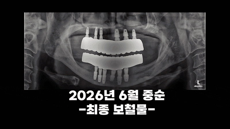 노본아치 임플란트 회복기간 뼈이식 없으면 더 빠른지 비교하기 관련 이미지 7