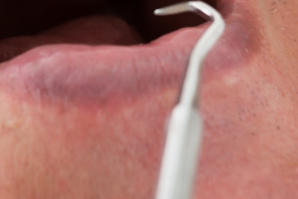 강남 노인임플란트 삶의 질이 달라져요 관련 이미지 16