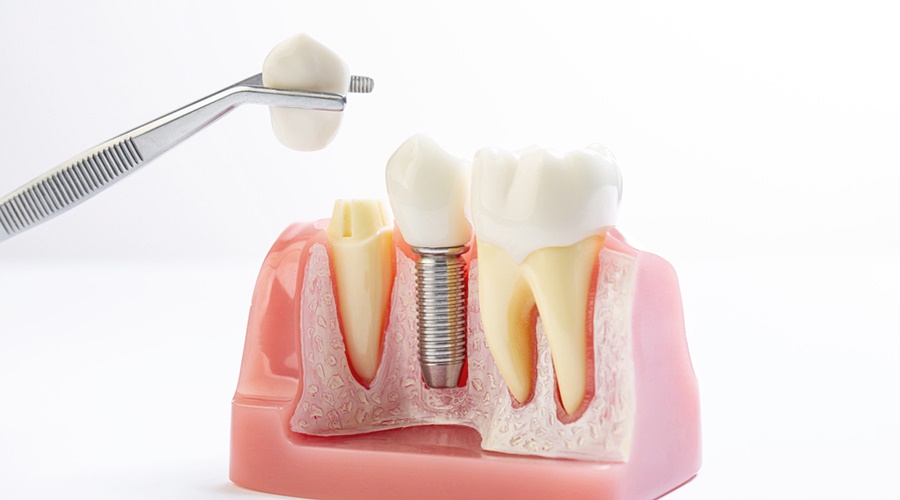국산 임플란트 종류 가격과 특징 비교하기 관련 이미지 3