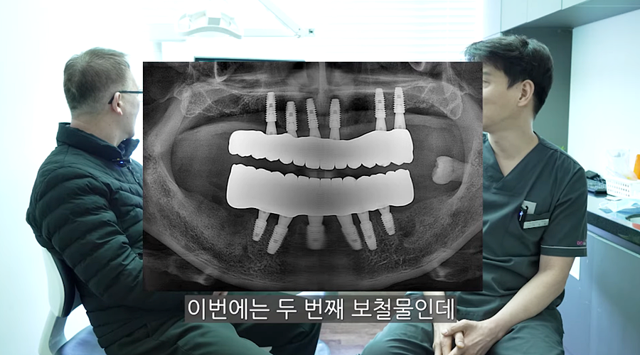 전체임플란트 수명 기간은 얼마나 관련 이미지 6