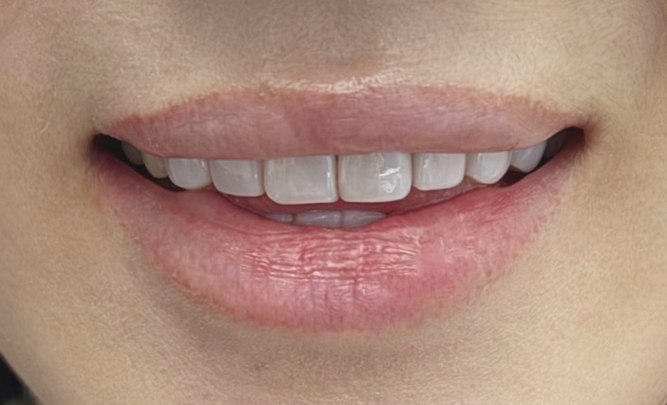 강남압구정라미네이트 부작용 미리 알아두기 관련 이미지 6