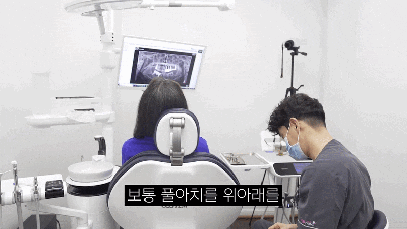 무치악 틀니 대신 가능한 풀아치 임플란트 관련 이미지 8