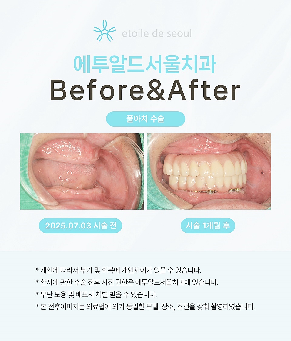 압구정치과 뼈이식없는임플란트 노본아치로 관련 이미지 3