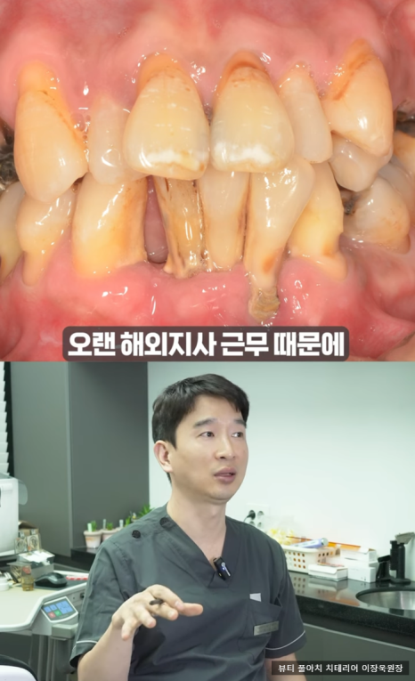 임플란트의 역사와 구조, 풀아치 임플란트 구조 차이점 비교 관련 이미지 9